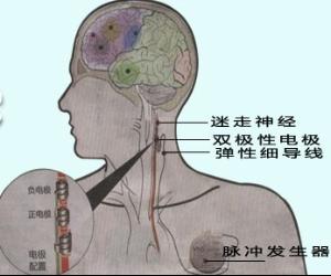 迷走神经刺激术治疗复杂癫痫
